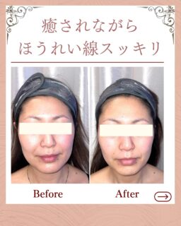 お客様の変化| MEGUMI式メソッド

◾️30代後半|女性

◾️お顔の悩みについて

☑️ほうれい線が気になり出した
☑️20代からむくみがひどい疲れがとれない
 
 

◾️悩みの原因
1日中、立ち仕事でふくらはぎの凝り、肩の凝りによって身体がゆがんでしまい顔の筋肉を引き下げてしまっていました。
 
また、顔の筋肉の歪みがありリンパが滞って、フェイスラインがむくんでいました。
 
お肌はターンオーバーが乱れ、ハリ弾力が低下してお顔のたるみとなっていました。
 
 
 
 ◾️お客様の変化
1回目から6回目
お悩みの根本改善をするため
MEGUMI式メソッドを実践

＊当サロンはその場しのぎのケアは行いません。
お顔のたるみは根本改善をしていかなければ、数日たてば元に戻るという堂々めぐりになってしまうからです。

＊その為、施術1回で全てをケアするのではなく6週間をかけて、週1回の集中ケアを行っています。
 
 

◾️お客様の声
6週間かけて丁寧に身体、顔の筋肉と
肌の土台を整えていきました。

“気にされていた顔周りのもたつきが
スッキリして肩凝りも改善されて
疲れにくくなってきて嬉しいです。”

ーーーーーーーーーーーーーーーー

MEGUMI式メソッドとは？
身体と肌の仕組みに基づき、たるみの根本原因となる身体の歪み、リンパのつまり、表情筋の凝り固まり、皮膚のターンオーバーの乱れ、すべてを整えて元の状態に戻していくプログラムになります。

ーーーーーーーーーーーーーーーー

今だけ！10月限定の体験はこちら▼ 
📍ご予約、お問い合わせはプロフィールからリンクへ
@megumi_kogao_taito 

ﾟ+:｡.｡:+ﾟﾟ+:｡.｡:+ﾟﾟ+:｡.｡:+ﾟﾟ+:｡.｡:+ﾟﾟ+:

【東京・浅草橋】
／
40代からの老け顔専門家
＼

"ほうれい線スッキリたるみ改善メソッド"
【限定のご体験コース】をご用意しております。

📍ご予約、お問い合わせはプロフィールのリンクからどうぞ。

💁‍♀️プロフィールはこちら
@megumi_kogao_taito