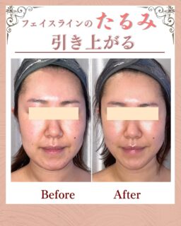 このお客様は、

30代後半|女性
▶︎フェイスラインのもたつきが気になる
▶︎肩凝り、首凝りがひどく常に辛い
というお悩みを改善したくて、
当サロンにご来店くださいました。

デスクワークで目を酷使。
指先を使う時間が8時間以上、
それを、週５日間されている事で
身体の筋肉が歪み、
フェイスラインの筋肉を引き下げてしまっている・・と、

とても「お疲れのお顔」状態でした。

慢性的な肩凝り、首凝りによってリンパ、
血液が滞りフェイスラインのむくみまで。
 
そんなお客様に
施術させていただいたMEGUMI式メソッド💆‍♀️

お悩みの根本改善をするため
たるみ改善プログラムを実践✨

6週間かけて丁寧に丁寧に・・✨
独自の技法で
身体、顔の筋肉と
肌の土台を整えました。

その結果、
「顔周り」がスッキリして、
職場の人にも痩せました？と言われ、
肩と首がとても楽になられました✨

私もとっても嬉しいです☺️

——– 当サロンについて———⁣

当店はお顔の悩みを根本改善するために
【正しい習慣】を身につけていただくサロンです。

＊当店はその場しのぎのケアは行いません。
お顔のたるみは根本改善をしていかなければ、数日たてば元に戻るという堂々めぐりになってしまうからです。

＊お顔の悩みを改善するための正しい習慣を身につけていく為、施術1回のケアではなく6週間かけて、週1回の集中ケアを行っています。

━━━━━━━━━━━━━━

今だけ！11月限定の体験はこちら▼ 
📍ご予約、お問い合わせはプロフィールからリンクへ

ﾟ+:｡.｡:+ﾟﾟ+:｡.｡:+ﾟﾟ+:｡.｡:+ﾟﾟ+:｡.｡:+ﾟﾟ+:

【東京・浅草橋】
／
40代からの老け顔専門家
＼

"ほうれい線スッキリたるみ改善メソッド"
【限定のご体験コース】をご用意しております。

📍ご予約、お問い合わせはプロフィールのリンクからどうぞ。

💁‍♀️プロフィールはこちら
@megumi_kogao_taito

#老け顔改善プログラム#たるみ改善エステ#たるみ改善東京#東京浅草橋たるみ改善エステ