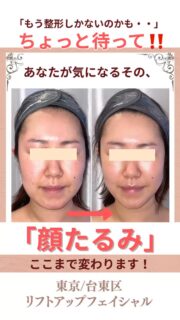 あなたも老け顔を卒業して
今の自分の顔を好きになりませんか？

くっきりほうれい線、頬のたるみ💭
でも整形は怖い、したくない・・
こんなお悩みありませんか？

私自身、老け顔に悩み辛かった…
でも、勇気を出して一歩踏み出し
生まれたのが独自のたるみ改善プログラム、
MEGUMI式メソッドです。

気持ちいいのに結果がすごい！
リフトアップエステで
あなたの理想のお顔へサポートします✨

投稿のお写真は思い悩んでいた事が
嘘のように明るく笑顔になった
お客さま達の変化の一部です。

「今の自分の顔が好きになれる若々しいお顔」に✨

今だけ限定3名様💆‍♀️
初回体験を特別価格にてご案内
📍ご予約、お問い合わせはプロフィールのリンクからどうぞ。

ﾟ+:｡.｡:+ﾟﾟ+:｡.｡:+ﾟﾟ+:｡.｡:+ﾟﾟ+:｡.｡:+ﾟﾟ+:

【東京・浅草橋】
／
40代からの老け顔専門家
＼

💁‍♀️プロフィールはこちら
@megumi_kogao_taito 

#東京浅草橋たるみ改善エステ #フェイシャルエステ#台東区浅草橋プライベートサロン