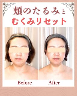 お客様の変化| MEGUMI式メソッド

◾️40代後半|女性

◾️お顔の悩みについて

✔︎頬のたるみ
✔︎顔のムクミ

 
 

◾️悩みの原因
お体と顔の血液と、リンパの滞りが強く、体の末端、手足と顔から頭皮がむくんでいる状態でした。

体のケアから優しい圧でリンパを傷つけないようにトリートメントを行いました。
体の状態が整ってから、お顔と頭皮のリンパ、血液の流れをスムーズにしていきました。
 

 
 
 
 ◾️お客様の変化
1回目から6回目
お悩みの根本改善をするため
MEGUMI式メソッド
たるみ改善プログラムを実践

体のケアから優しい圧でリンパを傷つけないようにトリートメントを行いました。
体の状態が整ってから、お顔と頭皮のリンパ、血液の流れをスムーズにしていきました

◾️お客様の声
気づいたら顔のむくみと頬のたるみが気になるようになっていました。

自分ではエイジングの化粧品を使ったりしましたが効果を感じず…
こちらのサロンを見つけて丁寧にケアしてもらったおかげで浮腫が本当になくなって、顔がすっきりして、すごく嬉しいです。

——– 当サロンについて———⁣

当店はお顔の悩みを根本改善するために
【正しい習慣】を身につけていただくサロンです。

＊当店はその場しのぎのケアは行いません。
お顔のたるみは根本改善をしていかなければ、数日たてば元に戻るという堂々めぐりになってしまうからです。

＊お顔の悩みを改善するための正しい習慣を身につけていく為、施術1回のケアではなく6週間かけて、週1回の集中ケアを行っています。

——– MEGUMI式メソッドとは？———⁣

身体と肌の仕組みに基づき、たるみの根本原因となる身体の歪み、リンパのつまり、表情筋の凝り固まり、皮膚のターンオーバーの乱れ、すべてを整えて元の状態に戻していくプログラムになります。

━━━━━━━━━━━━━━

✨今だけ！11月限定の体験はこちら▼ 
📍ご予約はプロフィールからリンクへ

▶︎ご質問はDMにどうぞ

ﾟ+:｡.｡:+ﾟﾟ+:｡.｡:+ﾟﾟ+:｡.｡:+ﾟﾟ+:｡.｡:+ﾟﾟ+:

【東京・浅草橋】
／
40代からの老け顔専門家
＼

"ほうれい線スッキリたるみ改善メソッド"
【限定のご体験コース】をご用意しております。

📍ご予はプロフィールのリンクからどうぞ。

💁‍♀️プロフィールはこちら
@megumi_kogao_taito 

#東京浅草橋たるみ改善エステ#フェイシャルエステ#ほうれい線が気になる #たるみが気になる #顔のむくみが気になる