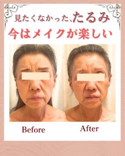 お客様の変化✨

このお客様は、
60代|女性
▶︎ お悩み
頬のたるみ
口元のたるみ
乾燥とシワ

▶︎たるみの原因
立ち仕事を続けていらっしゃったことで腰痛があり、右の腕と肩の張り感が強いことが原因で、顔の筋肉を引き下げお悩みのたるみが出ていました。
スキンケアの使い方の間違いで顔全体の乾燥と目元のシワが出ている状態。

▶︎お悩みの根本改善をするためのケア
たるみ改善プログラムを週1回
6週間、実践✨

▶︎6週間後のお声

正直、年齢的に「もうたるみは仕方ない」と思っていました。
今まで色々なケアやエステも試しましたが、
その場は少し良く見えても、
結局すぐ元に戻ってしまうことばかりで顔に不満があり鏡を見るのも嫌でした。
こちらのプログラムは
「顔だけでなく体の使い方やクセから整える」と聞き、半信半疑でしたが思い切って受けてみました。
通ううちに、頬の位置が以前より上がって顔がスッキリして元の状態に戻っていく、そんな変化を感じるようになりました。
メイクをするのが楽しくなりました。

何より嬉しかったのは、無理なことを押し付けられず、大竹さんが今の私に必要なケアを丁寧に話してくれた事です。
これからも定期的に通って
この状態を保っていきたいと思っています。

——– ご来店ありがとうございます☺️———⁣
お客さまは、エステの経験はありましたが半信半疑でご来店、体験後にお顔が明るくなり、すっきりした効果をご実感くださりMEGUMI式メソッドを受けて下さいました。
素敵な笑顔でお話も沢山してくださるようになって前向きになられたお姿が嬉しいです！

これからもお顔の管理、サポートさせて頂きます🍀

——– 当サロンについて———⁣

当店はお顔の悩みを根本改善するために
【正しい習慣】を身につけていただくサロンです。

＊当店はその場しのぎのケアは行いません。
お顔のたるみは根本改善をしていかなければ、数日たてば元に戻るという堂々めぐりになってしまうからです。

＊お顔の悩みを改善するための正しい習慣を身につけていく為、施術1回のケアではなく6週間かけて、週1回の集中ケアを行っています。

━━━━━━━━━━━━━━

今だけ！11月限定の体験はこちら▼ 
📍ご予約、お問い合わせはプロフィールからリンクへ

ﾟ+:｡.｡:+ﾟﾟ+:｡.｡:+ﾟﾟ+:｡.｡:+ﾟﾟ+:｡.｡:+ﾟﾟ+:

【東京・浅草橋】
／
40代からの老け顔専門家
たるみ改善フェイシャルエステ
＼

"ほうれい線スッキリたるみ改善メソッド"
今だけ！１月限定
【3名様ご体験コース】をご用意しております。

📍ご予約はプロフィールのリンクからどうぞ。

💁‍♀️プロフィールはこちら
@megumi_kogao_taito 

#東京浅草橋たるみ改善エステ #台東区浅草橋エステ#老け顔改善エステ#ほうれい線が気になる#目元たるみケアマリオネットライン改善フェイスラインの引き締め