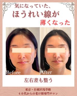お客様の変化| MEGUMI式メソッド
◾️30代後半|女性

◾️お顔の悩みについて
▶︎ほうれい線
▶︎目元のシワ

◾️悩みの原因
最近、朝鏡を見たときに
「ほうれい線、こんなに深かったっけ？」
「目元のシワ…増えてない？」
何もしないまま年齢だけ重ねることに、不安を感じてご来店くださいました。

お話を伺うと、
・パソコン作業が多い
・右の肩と首がガチガチ
・目の疲れが強い

実際に触れると、
右肩の強いコリと首の歪み。
眼精疲労から目元〜こめかみ〜
頭皮まで硬くなり、
顔のリンパが滞って
むくみが出ている状態でした。

 
 
 
 ◾️お客様の変化
1回の変化
お悩みの根本改善をするため
MEGUMI式メソッド
たるみ改善プログラムを実践

今回は右肩の深いコリを緩め、
首の歪みを整え
眼輪筋・こめかみ・頭皮を
ゆるめてリンパの流れを回復させました。

すると…
・ほうれい線が自然に薄く
・目元がぱっちり
・左右差が整い
・フェイスラインがスッキリ

ご本人も気づいていなかった
“右側の崩れ”が整ったことで、
顔全体が若々しい印象に戻りました。

たるみは年齢のせいだけではありません。
体の使い方、姿勢、筋肉の硬さが大きく関係しています。

「私も同じかも…」と感じた方は、
私に一度ご相談ください。

——– 当サロンについて———⁣

当店はお顔の悩みを根本改善するために
【正しい習慣】を身につけていただくサロンです。

＊当店はその場しのぎのケアは行いません。
お顔のたるみは根本改善をしていかなければ、数日たてば元に戻るという堂々めぐりになってしまうからです。

＊お顔の悩みを改善するための正しい習慣を身につけていく為、施術1回のケアではなく6週間かけて、週1回の集中ケアを行っています。

——– MEGUMI式メソッドとは？———⁣

身体と肌の仕組みに基づき、たるみの根本原因となる身体の歪み、リンパのつまり、表情筋の凝り固まり、皮膚のターンオーバーの乱れ、すべてを整えて元の状態に戻していくプログラムになります。

━━━━━━━━━━━━━━

今だけ！2月限定のご体験はこちら▼ 
📍プロフィールからリンクへ

ﾟ+:｡.｡:+ﾟﾟ+:｡.｡:+ﾟﾟ+:｡.｡:+ﾟﾟ+:｡.｡:+ﾟﾟ+:

【東京・浅草橋】
／
40代からの老け顔専門
たるみ改善フェイシャルエステ
＼

"ほうれい線スッキリたるみ改善メソッド"
【限定のご体験コース】をご用意しております。

📍ご体験の予約はプロフィールのリンクからどうぞ。

💁‍♀️プロフィールはこちら
@megumi_kogao_taito