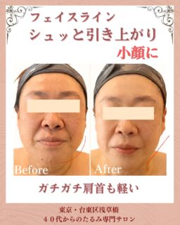 お客様の変化| MEGUMI式メソッド
◾️40代|女性

◾️お顔の悩みについて
▶︎フェイスラインのたるみ
▶︎ガチガチな肩と首

◾️ご来店のきっかけ
鏡を見た時に、顔周りがたるんでいることに気づいてショックだった。
このままじゃいけないと思い
こちらのサロンをInstagramで見つけて
思い切って予約しました。

 
 
 
 ◾️お客様の変化
1回の変化
お悩みの根本改善をするため
MEGUMI式メソッド
たるみ改善プログラムを6週間実践

このお客様は肩と首の歪みがあり
顔の筋肉を引き下げていました。

身体の歪みから整え
顔を流し引き上がけていくケアで
うっとりするほどフェイスラインが
引き上がりました。

フェイスラインがこんなに引き上がって
スッキリして見た目が若く見えるように
なった事が嬉しい。
職場の人から痩せた？って言われた。
と笑顔でお話くださいました。

たるみは年齢のせいだけではありません。
実は体の使い方、姿勢の歪みが大きく関係しています。

あなたのたるみ悩み
私にお任せください！

——– 当サロンについて———⁣

当店はお顔の悩みを根本改善するために
【正しい習慣】を身につけていただくサロンです。

＊当店はその場しのぎのケアは行いません。
お顔のたるみは根本改善をしていかなければ、数日たてば元に戻るという堂々めぐりになってしまうからです。

＊お顔の悩みを改善するための正しい習慣を身につけていく為、施術1回のケアではなく6週間かけて、週1回の集中ケアを行っています。

——– MEGUMI式メソッドとは？———⁣

身体と肌の仕組みに基づき、たるみの根本原因となる身体の歪み、リンパのつまり、表情筋の凝り固まり、皮膚のターンオーバーの乱れ、すべてを整えて元の状態に戻していくプログラムになります。

━━━━━━━━━━━━━━

今だけ！4月限定の体験はこちら▼ 
📍ご体験はプロフィールからリンクへ
3月🈵となります。

ﾟ+:｡.｡:+ﾟﾟ+:｡.｡:+ﾟﾟ+:｡.｡:+ﾟﾟ+:｡.｡:+ﾟﾟ+:

【東京・浅草橋】　
\整形しなくても若返る/
40代からのたるみ顔専門サロン✨

【2つの体験コース】をご用意しております。
📍詳細はハイライトの体験のご案内からどうぞ。

💁‍♀️プロフィールはこちら
@megumi_kogao_taito