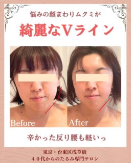 お客様の変化| MEGUMI式メソッド

◾️お顔の悩み
▶︎フェイスラインのむくみ

◾️原因
このお客様は立ち仕事によって
反り腰がひどく、腰とお尻の筋肉が
凝り固まって
顔のむくみを引き起こしていました。
 
 
 
 ◾️お客様の変化
お悩みの根本改善をするため
MEGUMI式メソッド
1回ご体験

まずは腰とお尻の凝りを緩めて
歪みが整えました。

顔の詰まりを流し
むくみをリセットしたので
自分のお顔に驚くほど
綺麗な横顔ラインに✨

顔が小さいー！！！
とにかく体が軽いっ
と笑顔でお話くださいました😊

顔のムクミ、たるみ、ほうれい線、マリオネットラインは年齢のせいだけではありません。
実は体の使い方、姿勢の歪みが大きく関係しています。

お顔の悩み、何でもご相談ください。

——– 当サロンについて———⁣

当店はお顔の悩みを根本改善するために
【正しい習慣】を身につけていただくサロンです。
＊当店はその場しのぎのケアは行いません。
お顔のたるみは根本改善をしていかなければ、数日たてば元に戻るという堂々めぐりになってしまうからです。

＊お顔の悩みを改善するための正しい習慣を身につけていく為、施術1回のケアではなくプログラムは6週間かけて週1回の集中ケアを行っています。

——– MEGUMI式メソッドとは？———⁣

身体と肌の仕組みに基づき、たるみの根本原因となる身体の歪み、リンパのつまり、表情筋の凝り固まり、皮膚のターンオーバーの乱れ、すべてを整えて元の状態に戻していくプログラムになります。

━━━━━━━━━━━━━━

見た目年齢マイナス5歳✨
あなたの【たるみ悩み】お任せください！
📍ご体験はプロフィールからリンクへ

ﾟ+:｡.｡:+ﾟﾟ+:｡.｡:+ﾟﾟ+:｡.｡:+ﾟﾟ+:｡.｡:+ﾟﾟ+:

【東京・浅草橋】　
40代からのたるみ顔専門サロン✨
📌総武線浅草橋駅・西口改札から徒歩3分

＼整形しなくても若返る／
・ぼやけた輪郭をシャープに変えて横顔美人に
・首・肩を流してお顔を引き上げる
・この先のキレイも徹底管理
​
・エステ歴20年／施術実績1.9万人
・エステ技術国際ライセンス保持
​
体験はこちら👇
【2つの体験コース】をご用意しております。
📍詳細はハイライトの体験のご案内からどうぞ。

💁‍♀️予約はプロフィールからリンクへ
@megumi_kogao_taito