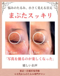 喜びの声をいただきました✨

▶︎50代|女性
▶︎ お悩み
小さくなった目元
重たいまぶた
目のたるみ

▶︎ご来店きっかけ
目元のたるみが気になって、昔より目が小さくなった感じがしていました。
写真を撮るのも嫌になってきて、何をしたらいいかわからず、インスタで見つけて思い切って予約しました。

▶︎お悩みの根本改善をするためのケア
たるみ改善プログラム週1回
6週間を実践✨

▶︎6週間後のお声
施術は毎回すごく気持ちよくて、
終わると目元がスッキリしました。

回数を重ねるたびに、たるみが変わってきて
6回終わる頃には
「昔の自分の目元みたい！」って大竹先生とお話して、本当に嬉しかったです。
最近は写真を撮るのが楽しくなりました♡

——– 当サロンについて———⁣

当店はお顔の悩みを根本改善するために
【正しい習慣】を身につけていただくサロンです。

＊当店はその場しのぎのケアは行いません。
お顔のたるみは根本改善をしていかなければ、数日たてば元に戻るという堂々めぐりになってしまうからです。

＊お顔の悩みを改善するための正しい習慣を身につけていく為、施術1回のケアではなくプログラムは6週間かけて週1回の集中ケアを行っています。

——– MEGUMI式メソッドとは？———⁣

身体と肌の仕組みに基づき、たるみの根本原因となる身体の歪み、リンパのつまり、表情筋の凝り固まり、皮膚のターンオーバーの乱れ、すべてを整えて元の状態に戻していくプログラムになります。

━━━━━━━━━━━━━━

見た目年齢マイナス5歳✨
あなたの【たるみ悩み】お任せください！
📍ご体験はプロフィールからリンクへ

ﾟ+:｡.｡:+ﾟﾟ+:｡.｡:+ﾟﾟ+:｡.｡:+ﾟﾟ+:｡.｡:+ﾟﾟ+:

【東京・浅草橋】　
40代からのたるみ顔専門サロン✨
📌総武線浅草橋駅・西口改札から徒歩3分
　
＼整形しなくても若返る／
・ぼやけた輪郭をシャープに変えて横顔美人に
・首・肩を流してお顔を引き上げる
・この先のキレイも徹底管理
​
・エステ歴20年／施術実績1.9万人
・エステ技術国際ライセンス保持
​
体験はこちら👇5月🈵
※6月新規予約スタート❗️
【2つの体験コース】をご用意しております。
📍詳細はハイライトの体験のご案内からどうぞ。

💁‍♀️予約はプロフィールからリンクへ
@megumi_kogao_taito