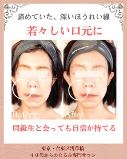 お客様の変化

▶︎50代|女性

▶︎ お悩み
深くなったほうれい線
顔まわりのたるみ

▶︎ご来店きっかけ
50代になってから、笑顔は変わっていないはずなのに、口元のほうれい線だけが目立つようになり、写真を撮ったときにこんなに老けて見えるんだとショックでした。
こちらを見つけて予約しました。

▶︎お悩みの根本改善をするためのケア
たるみ改善プログラム週1回
6週間を実践✨

▶︎6週間後のお声
ハンドマッサージで気持ちが良く、特に施術の後は口周りがスッキリして、首や肩が軽くなります。
紺続は力なりで、顔のキメの細かさやハリは同世代の友達と比べると良い状能なのでプリンセススマイル
様々です。
これからもますます私のアンチェイジング対策として、お世話になります。

——– 当サロンについて———⁣

当店はお顔の悩みを根本改善するために
【正しい習慣】を身につけていただくサロンです。

＊当店はその場しのぎのケアは行いません。
お顔のたるみは根本改善をしていかなければ、数日たてば元に戻るという堂々めぐりになってしまうからです。

＊お顔の悩みを改善するための正しい習慣を身につけていく為、施術1回のケアではなくプログラムは6週間かけて週1回の集中ケアを行っています。

——– MEGUMI式メソッドとは？———⁣

身体と肌の仕組みに基づき、たるみの根本原因となる身体の歪み、リンパのつまり、表情筋の凝り固まり、皮膚のターンオーバーの乱れ、すべてを整えて元の状態に戻していくプログラムになります。

━━━━━━━━━━━━━━

見た目年齢マイナス5歳✨
あなたの【たるみ悩み】お任せください！
📍ご体験はプロフィールからリンクへ

ﾟ+:｡.｡:+ﾟﾟ+:｡.｡:+ﾟﾟ+:｡.｡:+ﾟﾟ+:｡.｡:+ﾟﾟ+:

【東京・浅草橋】　
40代からのたるみ顔専門サロン✨
📌総武線浅草橋駅・西口改札から徒歩3分
　
＼整形しなくても若返る／
・ぼやけた輪郭をシャープに変えて横顔美人に
・首・肩を流してお顔を引き上げる
・この先のキレイも徹底管理
​
・エステ歴20年／施術実績1.9万人
・エステ技術国際ライセンス保持
​
体験はこちら👇
※8月新規予約は残り1名様です。

【2つの体験コース】をご用意しております。
📍詳細はハイライトの体験のご案内からどうぞ。

💁‍♀️予約はプロフィールからリンクへ
@megumi_kogao_taito