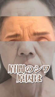 眉間のシワ、寄せる癖だと思ってます？

・頭皮の凝り
・眼精疲労
・ストレスが溜まりやすい

そのままにすると…

・眉間のシワが深くなって定着
・いつも怒っている様な顔に

こんな影響が出やすくなります。

だからこそ、
40代からの眉間のシワ改善は
顔だけをケアするのではなく、
頭皮にポイントがあるんです。

「私のことかも」と思った方は、
ぜひ、ご相談ください。

——– 当サロンについて———⁣

当店はお顔の悩みを根本改善するために
【正しい習慣】を身につけていただくサロンです。

＊当店はその場しのぎのケアは行いません。
お顔のたるみは根本改善をしていかなければ、数日たてば元に戻るという堂々めぐりになってしまうからです。

＊お顔の悩みを改善するための正しい習慣を身につけていく為、施術1回のケアではなくプログラムは6週間かけて週1回の集中ケアを行っています。

——– MEGUMI式メソッドとは？———⁣

身体と肌の仕組みに基づき、たるみの根本原因となる身体の歪み、リンパのつまり、表情筋の凝り固まり、皮膚のターンオーバーの乱れ、すべてを整えて元の状態に戻していくプログラムになります。

━━━━━━━━━━━━━━

見た目年齢マイナス5歳✨
あなたの【たるみ悩み】お任せください！
📍ご体験はプロフィールからリンクへ

ﾟ+:｡.｡:+ﾟﾟ+:｡.｡:+ﾟﾟ+:｡.｡:+ﾟﾟ+:｡.｡:+ﾟﾟ+:
【東京・浅草橋】　
40代からのたるみ顔専門サロン✨
📌総武線浅草橋駅・西口改札から徒歩3分
　
＼整形しなくても若返る／
・ぼやけた輪郭をシャープに変えて横顔美人に
・首・肩を流してお顔を引き上げる
・この先のキレイも徹底管理
​
・エステ歴20年／施術実績1.9万人
・エステ技術国際ライセンス保持
​
体験はこちら👇
※9月のご新規枠はのこり1枠
【2つの体験コ