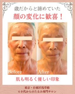 お客様の変化
▶︎60代|女性

▶︎ お悩
顔全体のたるみ
シミ
肩と首凝り

▶︎ご来店きっかけ
年齢もあり、顔のたるみが自分ではどうしたらわからなく、インスタを見て予約しました。

▶︎お悩みの根本改善をするためのケア
たるみ改善プログラム週1回
6週間を実践✨

▶︎6週間後のお声
やってもらった日は、肌がもちもちでスッキリしていて自宅に帰ってからも鏡で見て嬉しくなりました。
インスタを見てたから、あんなに変わるの本当かな？って半信半疑だったのですが、自分で体験して変化に驚きと嬉しさでいっぱいです。　

——– 当サロンについて———⁣

当店はお顔の悩みを根本改善するために
【正しい習慣】を身につけていただくサロンです。

＊当店はその場しのぎのケアは行いません。
お顔のたるみは根本改善をしていかなければ、数日たてば元に戻るという堂々めぐりになってしまうからです。

＊お顔の悩みを改善するための正しい習慣を身につけていく為、施術1回のケアではなくプログラムは6週間かけて週1回の集中ケアを行っています。

——– MEGUMI式メソッドとは？———⁣

身体と肌の仕組みに基づき、たるみの根本原因となる身体の歪み、リンパのつまり、表情筋の凝り固まり、皮膚のターンオーバーの乱れ、すべてを整えて元の状態に戻していくプログラムになります。

━━━━━━━━━━━━━━

見た目年齢マイナス5歳✨
あなたの【たるみ悩み】お任せください！
📍ご体験はプロフィールからリンクへ

ﾟ+:｡.｡:+ﾟﾟ+:｡.｡:+ﾟﾟ+:｡.｡:+ﾟﾟ+:｡.｡:+ﾟﾟ+:

【東京・浅草橋】　
40代からのたるみ顔専門サロン✨
📌総武線浅草橋駅・西口改札から徒歩3分
　
＼整形しなくても若返る／
・ぼやけた輪郭をシャープに変えて横顔美人に
・首・肩を流してお顔を引き上げる
・この先のキレイも徹底管理
​
・エステ歴20年／施術実績1.9万人
・エステ技術国際ライセンス保持
​
体験はこちら👇
※10月残り1名 ／  11月残り2名
【2つの体験コース】をご用意しております。
📍詳細はハイライトの体験のご案内からどうぞ。

💁‍♀️予約はプロフィールからリンクへ
@megumi_kogao_taito