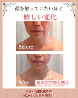 お客様の変化
▶︎40代|女性

▶︎ お悩
顔全体のたるみ
ほうれい線

▶︎ご来店きっかけ
サロンのインスタをみて、たるみの原因は首や肩、背中の凝りだと知り、肩こりや姿勢も気になっていたので体を教えてもらえたら何か変わるかも！と思い伺いました。

▶︎お悩みの根本改善をするためのケア
たるみ改善プログラム週1回
6週間を実践✨

▶︎6週間後のお声
たるみ改善プログラム（6回）のコースを選びましたが、1回目の施術後から、頬がやわらかくなり、目もパッチリ、トーンアップもしていて帰りの電車の中でも、顔をさわってしまうほど嬉しかったです！
6回目には長年気になっていた有り（特に左がポッコリしていた部分）
も改善されビックリです！！

これからも定期的に伺い。
心も体もスッキリし、年数を重ねても自信が持てるようになります。

——– 当サロンについて———⁣

当店はお顔の悩みを根本改善するために
【正しい習慣】を身につけていただくサロンです。

＊当店はその場しのぎのケアは行いません。
お顔のたるみは根本改善をしていかなければ、数日たてば元に戻るという堂々めぐりになってしまうからです。

＊お顔の悩みを改善するための正しい習慣を身につけていく為、施術1回のケアではなくプログラムは6週間かけて週1回の集中ケアを行っています。

——– MEGUMI式メソッドとは？———⁣

身体と肌の仕組みに基づき、たるみの根本原因となる身体の歪み、リンパのつまり、表情筋の凝り固まり、皮膚のターンオーバーの乱れ、すべてを整えて元の状態に戻していくプログラムになります。

━━━━━━━━━━━━━━

見た目年齢マイナス5歳✨
あなたの【たるみ悩み】お任せください！
📍ご体験はプロフィールからリンクへ

ﾟ+:｡.｡:+ﾟﾟ+:｡.｡:+ﾟﾟ+:｡.｡:+ﾟﾟ+:｡.｡:+ﾟﾟ+:

【東京・浅草橋】　
40代からのたるみ顔専門サロン✨
📌総武線浅草橋駅・西口改札から徒歩3分
　
＼整形しなくても若返る／
・ぼやけた輪郭をシャープに変えて横顔美人に
・首・肩を流してお顔を引き上げる
・この先のキレイも徹底管理
​
・エステ歴20年／施術実績1.9万人
・エステ技術国際ライセンス保持
​
初回体験はこちら👇
【2つの体験コース】をご用意しております。
📍詳細はハイライトの体験のご案内からどうぞ。

💁‍♀️予約はプロフィールからリンクへ
@megumi_kogao_taito